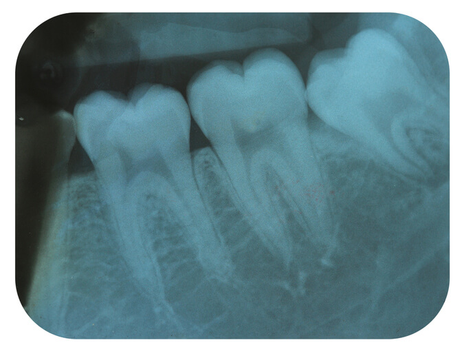 root canal x-ray at Beach Grove Dental Tsawwassen