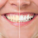 teeth whitening before and after image - beach grove dental tsawwassen - Cosmetic Dentistry