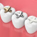 digital image of teeth with gold, amalgam and ceramic dental fillings