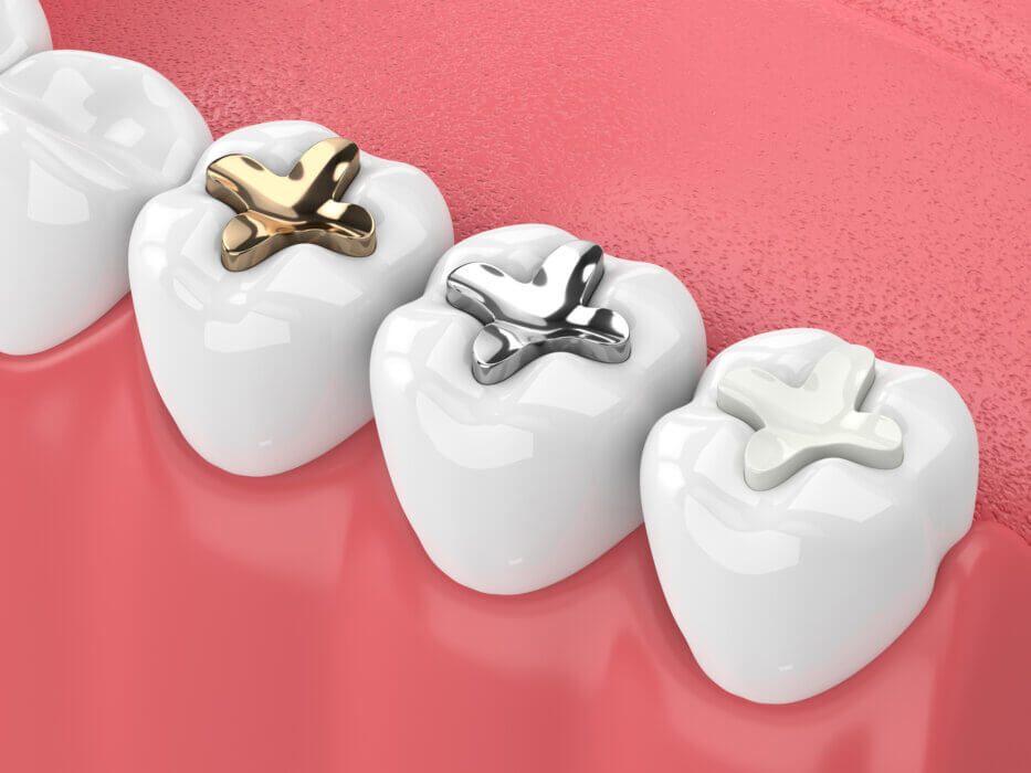 digital image of teeth with gold, amalgam and ceramic dental fillings