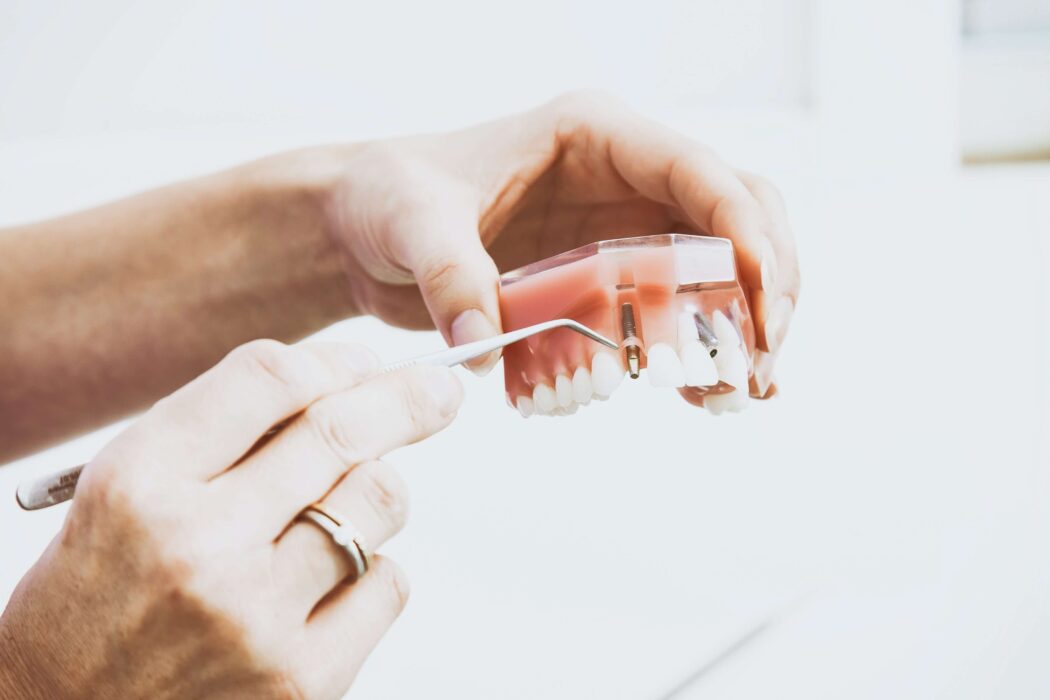 dental-implants-model