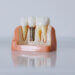 dental implants model of teeth