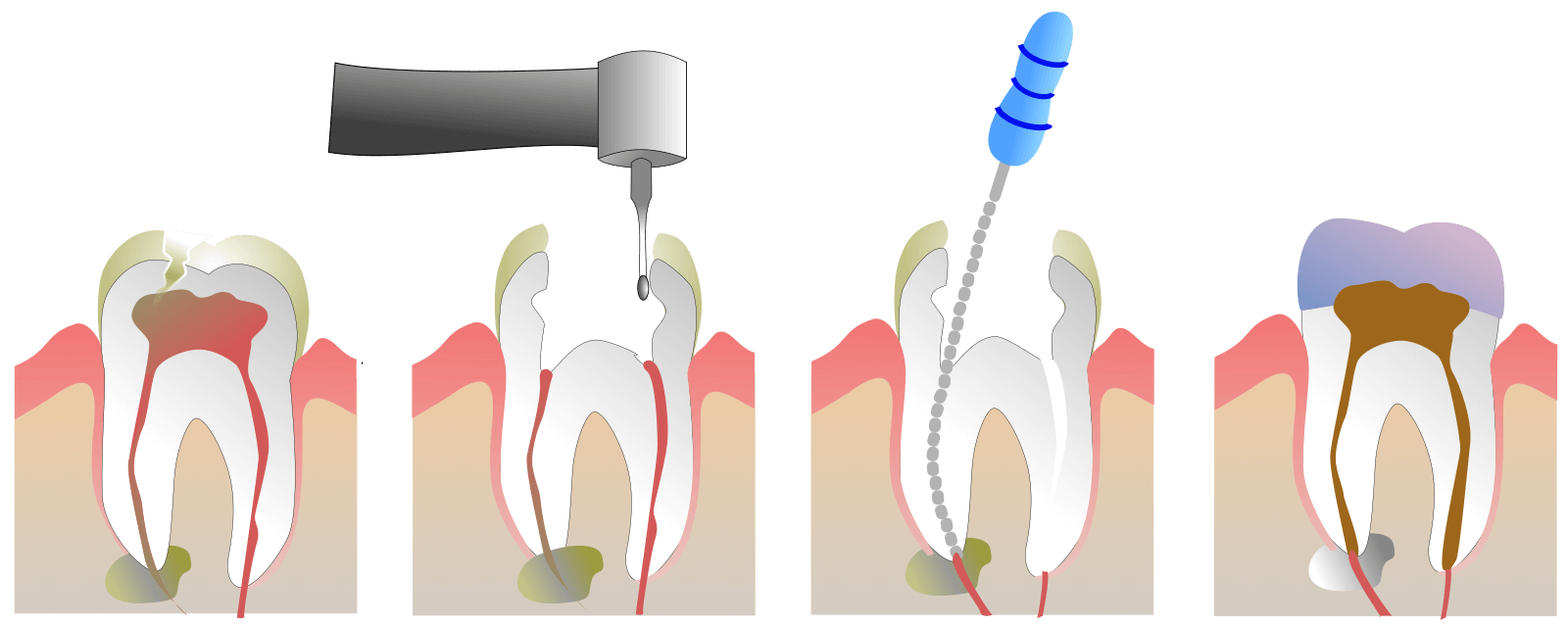 A diagram showing steps of root canal procedure