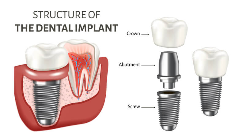 a diagram explaining the structure of a dental implant